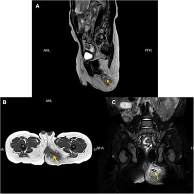 Case Report: Perianal infection in children caused by ingested jujube pits: a report of two cases